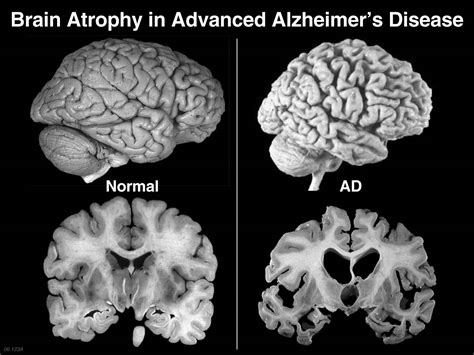 Is it normal for Alzheimers patients to moan, but not hurt ...